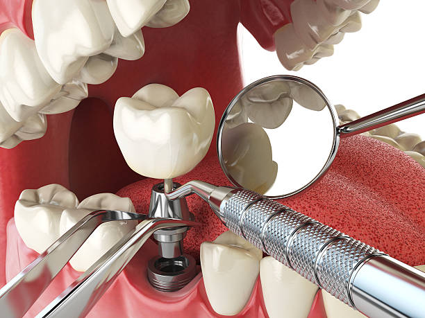 Best Emergency Treatment for Dental Infections or Abscesses in Toledo, OR
